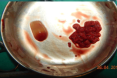 Cortico cancellous bone graft harvested from iliac site.