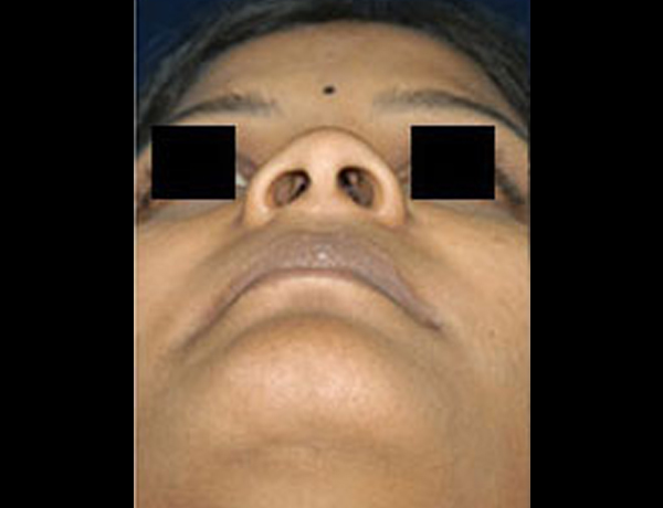 Preop