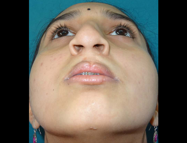 Preop