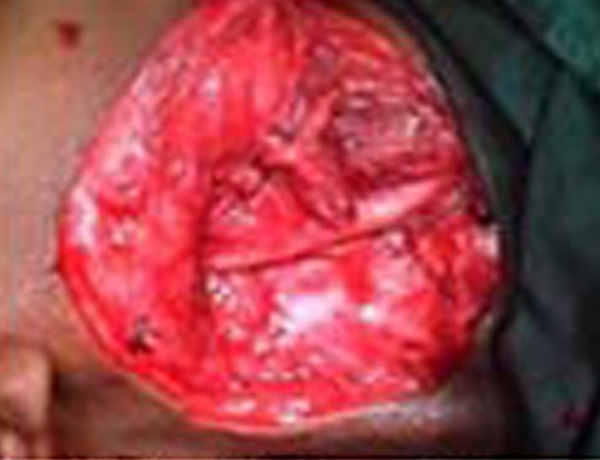 Intraop