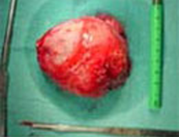 Intraop