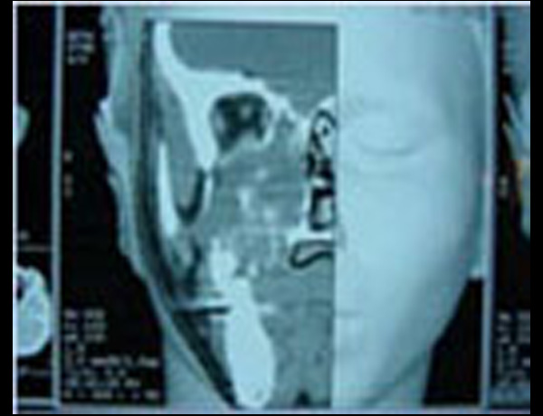 3D Reconstruction CT Scan