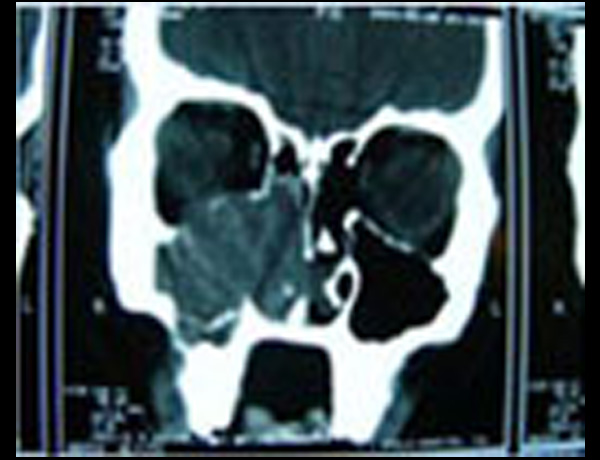CT Scan PNS View