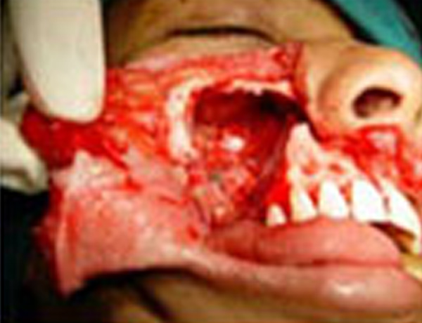 Tumor Resected