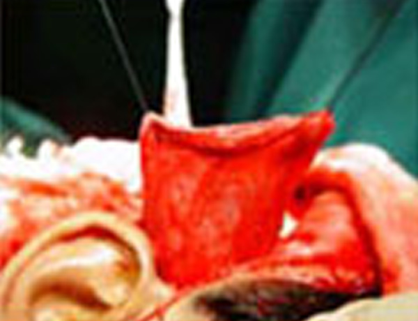 Temporalis muscle harvested