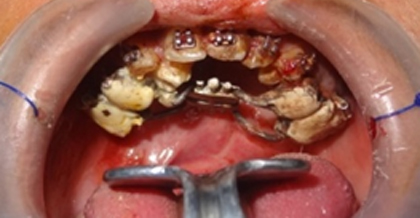 Anterior maxillary distraction device
