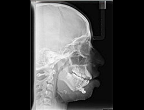Postop Xray Lateral Ceph
