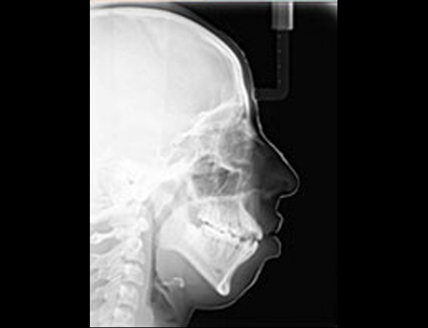Preop Xray Lateral Ceph