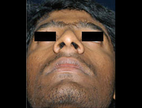 Preop