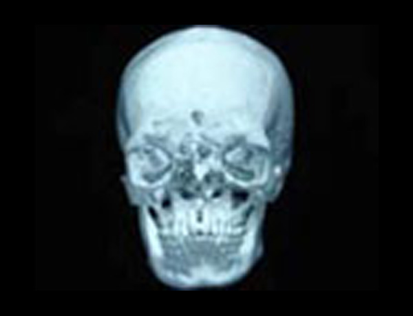 3D CT Scan