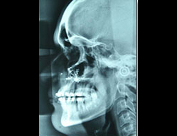 Postop Xray Lateral Ceph