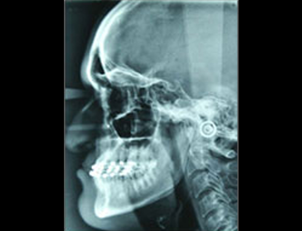Preop Xray Lateral Ceph