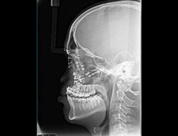 Postop Xray Lateral Ceph