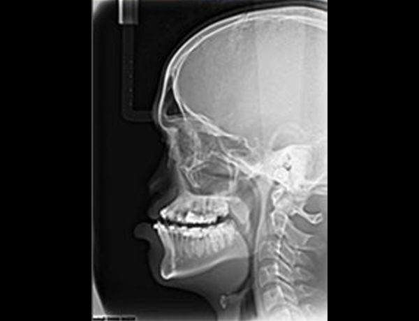 Preop Xray Lateral Ceph