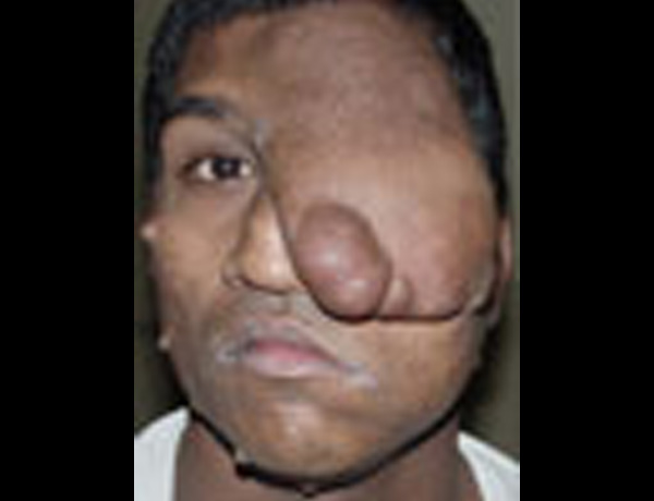 Preop