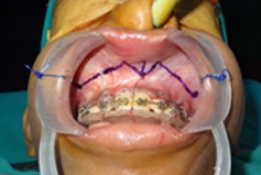 Incision marking