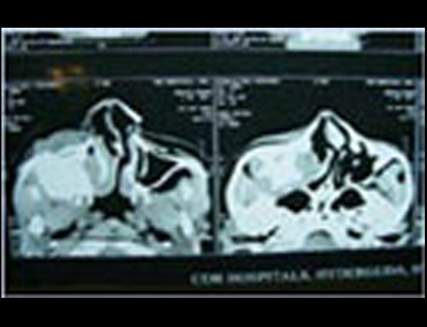 Preop Xray