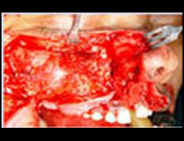 Intraop