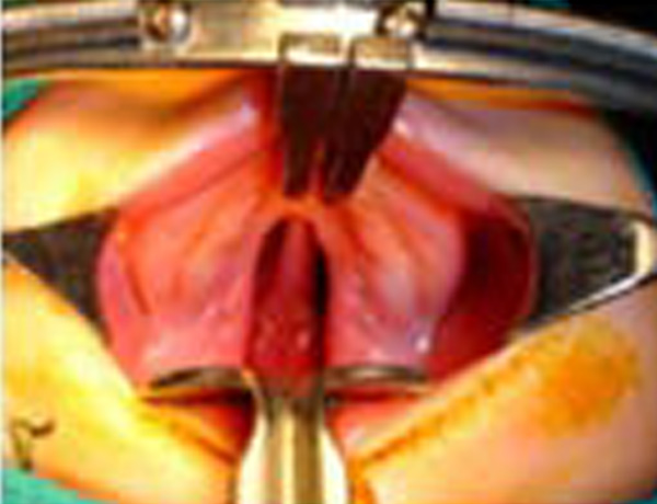 Preop