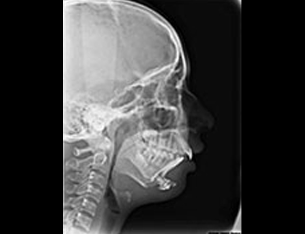 Postop Xray Lateral Ceph