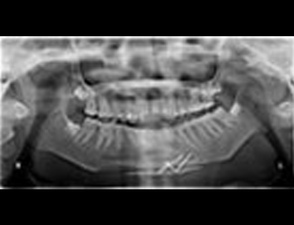 Postop Xray