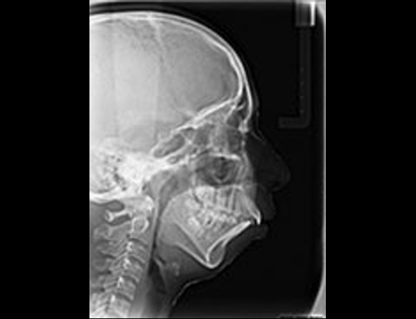 Preop Xray Lateral Ceph
