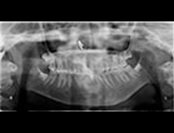 Preop Xray