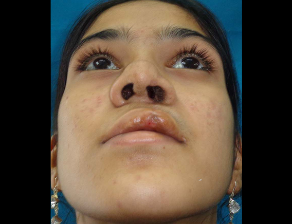 Post op