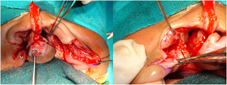 Type I b Minimal muscle dissection ensuring dissection of transverse nasalis muscle.