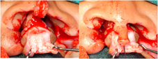 Dissection of the prolabium is done to separate vestibular mucosa from skin. All the fibro-adipose tissue is removed and the vestibular mucosa is trimmed
