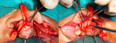 Periosteoplasty is done in patients who have associated cleft alveolus and/or cleft palate. It is done to receive the bone graft later on and to minimize the formation of “Y” junction fistula