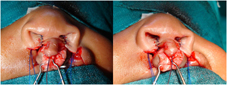 Nasal sill is closed bilaterally