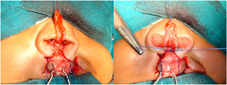 Ala of the nose is stabilized syymetrically
