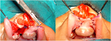 Vestibule formed with tissue from prolabium and corresponding labial mucosa