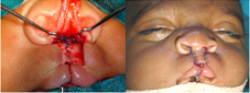 Muscle approximation and closure is done