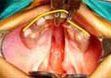 Type I b Unilateral with palatal shelves at the different level anteriorly