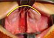 Type II a Bilateral with palatal shelves at the same level anteriorly