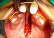 Type II b Bilateral with palatal shelves at the different level anteriorly