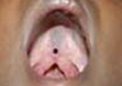 Type IV a Submucons Cleft of Palate
