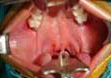 Type IV b Bifid Uvula