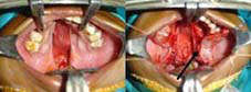 edial Incisions: uvula to anterior. Lateral incisions: maxilary tuberosity to anterior. Palatopharyngeus muscle and sutured. superficial levator muscles are detached from posterior palate.