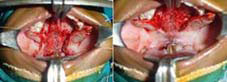 Nasal layer carefully preserved and detached from superior to the palatal shelves and Uvula sutures posteriorly
