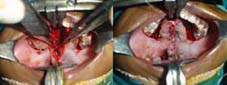 Detached muscle sutured to the corresponding muscle on the other side. Palatal mucosa approximated