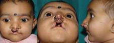 Type I a Complete cleft on both sides