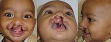 Type I b Complete cleft on one side and incomplete cleft on the other.