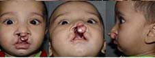 Type II b Prolabial-columellar angle < 120° .