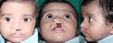 Type I Submucous cleft
