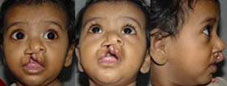 Type IV Extending beyond whiteroll involving the nose