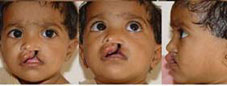Type I Submucous cleft