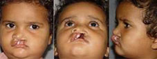 Type IV Extending beyond whiteroll involving the nose